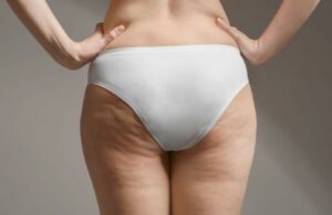 cellulite sur fesses et cuisses